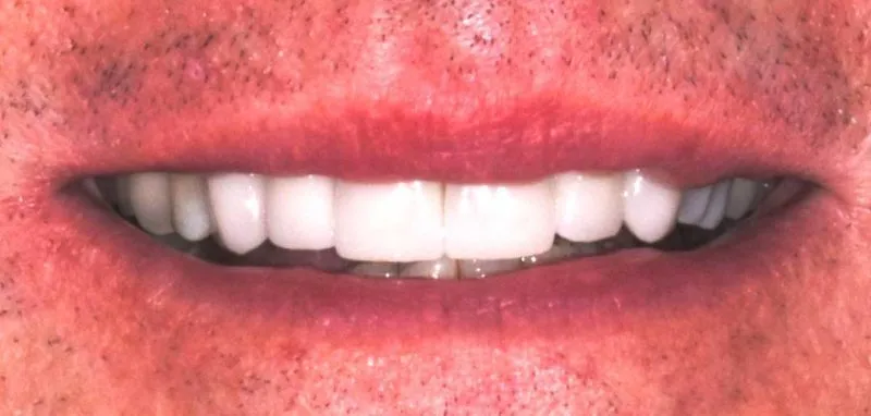 White teeth