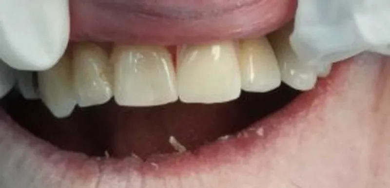 White teeth