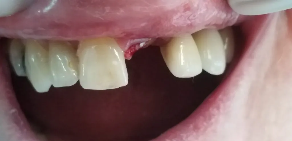 Extracted central tooth