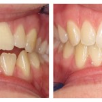 Teeth before and after invisalign