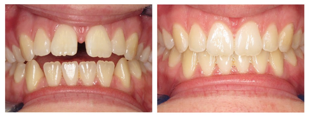 Teeth before and after invisalign