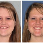 A woman before and after invisalign