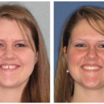 A woman before and after invisalign