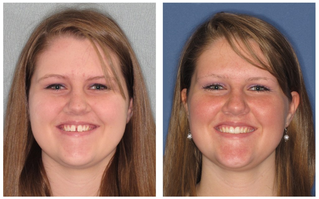 A woman before and after invisalign