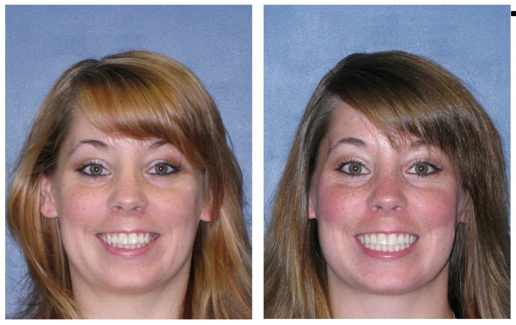 A woman before and after invisalign