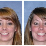 A woman before and after invisalign