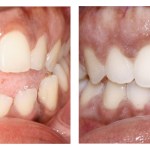 Teeth before and after invisalign