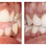 Teeth before and after invisalign