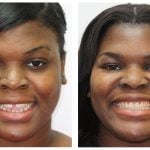 A woman before and after invisalign