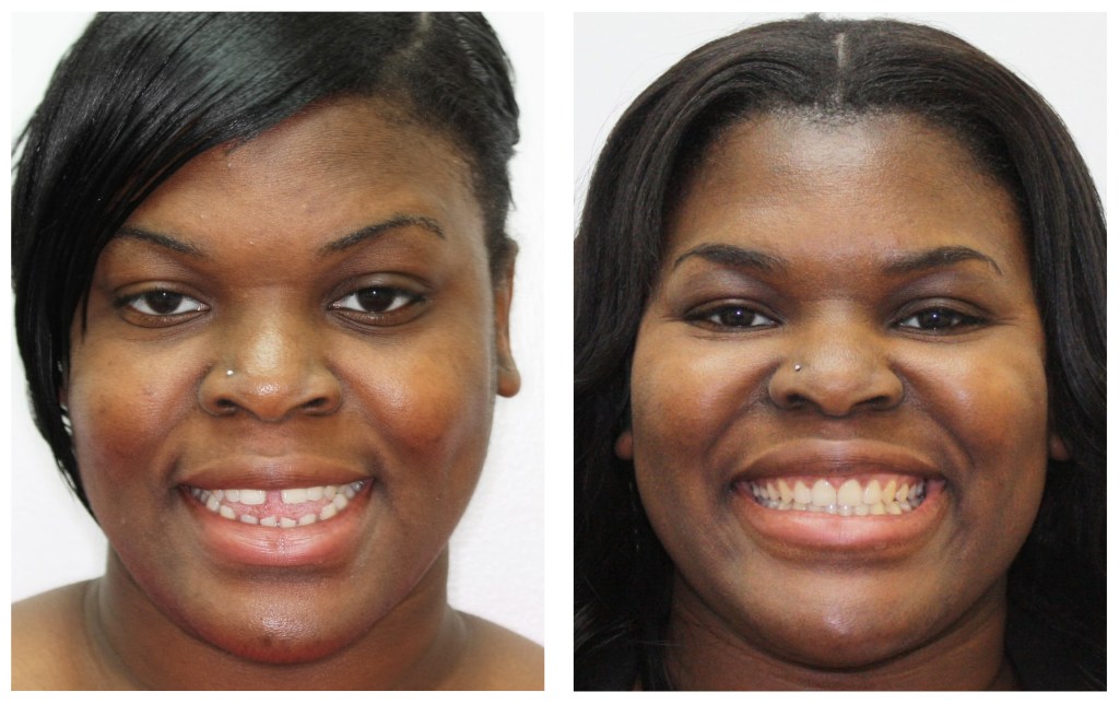 A woman before and after invisalign