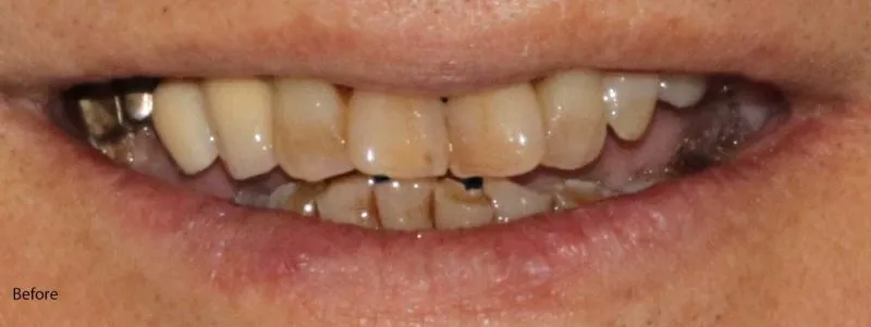 Crooked and stained teeth