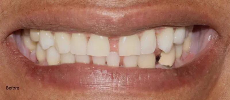 White teeth