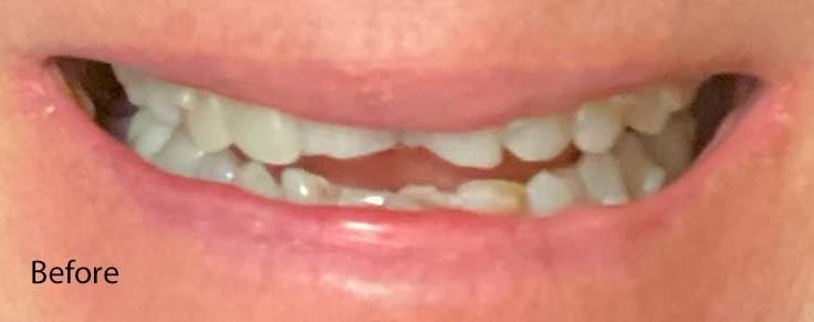 Chipped central incisors